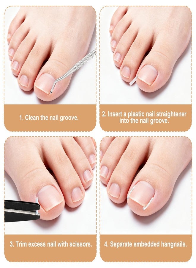 Sinbana 55pcs Ingrown Toenail Set, Include Breathable In-Growing Toenail Strips Curved Toes Patches Lifting Pedicure Tools & Pads Suitable for Home Pedicure - Image 5